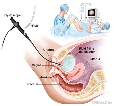 Cystoscope