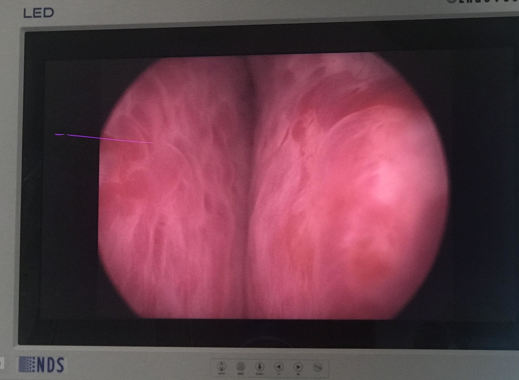 CRECIMIENTO OBSTRUCTIVO DE PROSTATA
