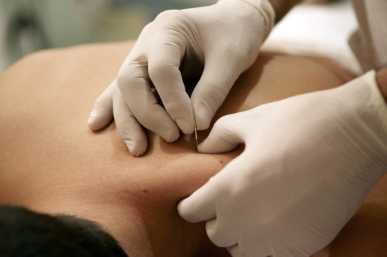 Dry needling