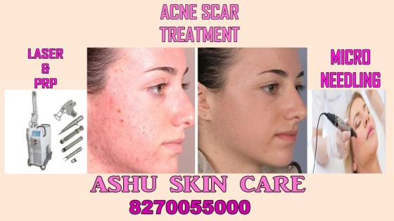 Acne  scar treatment 