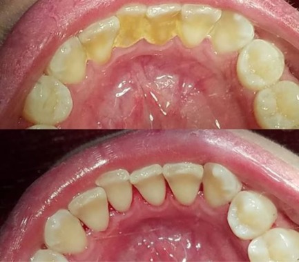 Limpieza dental (destartraje) desde $20000