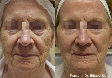 Fractora