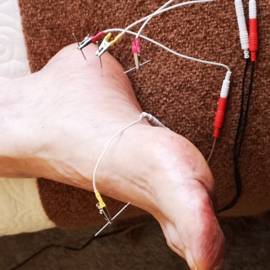 Acupuntura A Domicilio