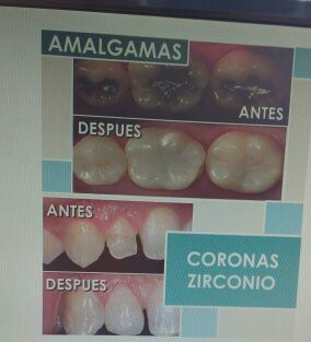 Tratamientos dentales promoción