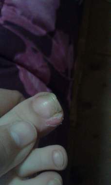 Onicomicosis distal con onicocriptosis lateral derecho, niño de 3 años.