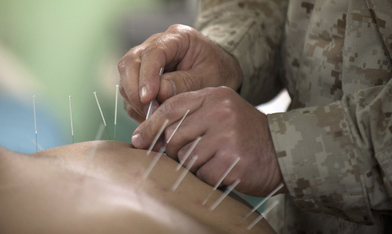 Acupuncture