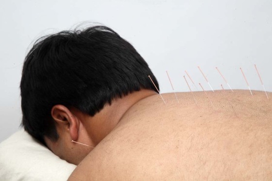 Acupuncture therapy