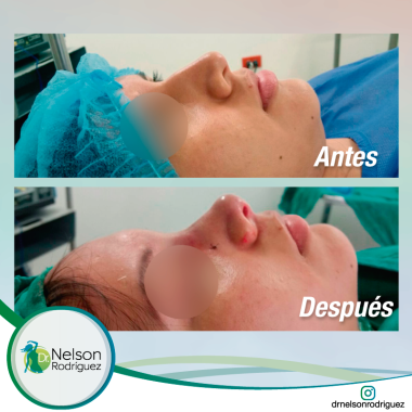 Rinoplastia Guayaquil