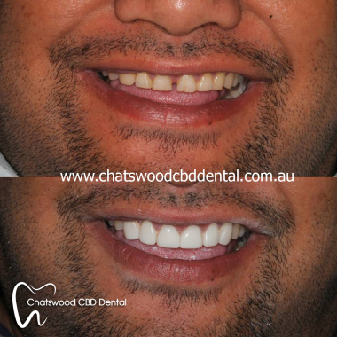 Chatswood_porcelain_veneer.jpg