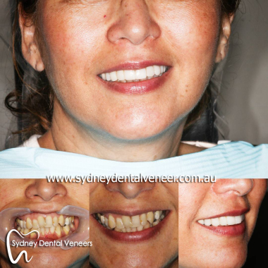 Composite_veneer_dentistry.jpg