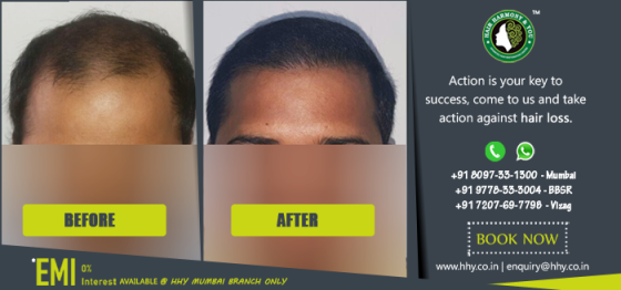 Get Rid of all Hair Loss Problems‎, Best Hair Transplant in Mumbai.