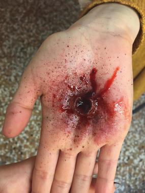 Ferita da arma da fuoco
