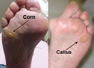 Corns and callus can be removed in the comfort of your own home.