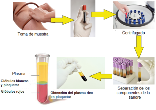 Es una tecnica con muy buenos resultados y sin que existan efectos secundario, ideal para reparaciones articulares, un servicio que ya tenemos activo