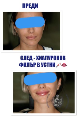 Преди/След ➡️ Хиалуронов филър в устни
