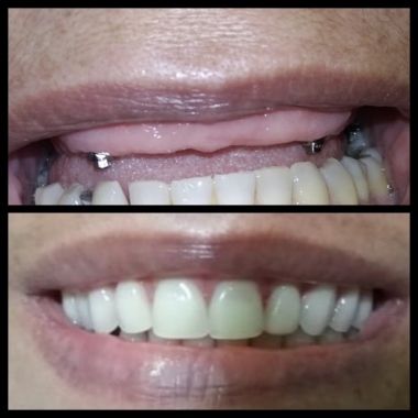 Implantes e prótese sobre implantes.