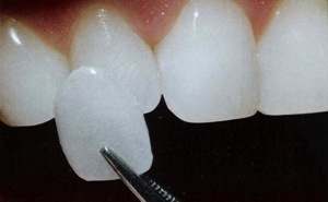 dental veneers