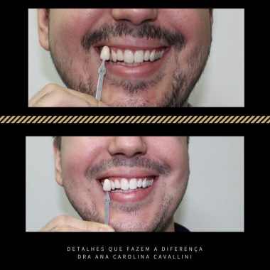 Clareamento dental